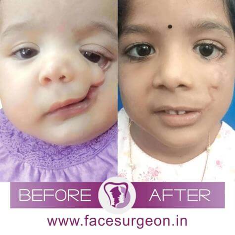 Cleft Lip Palate India
