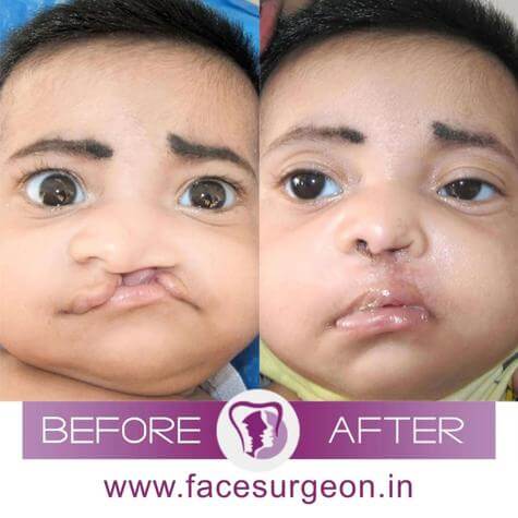 Cleft Lip Palate Surgery India