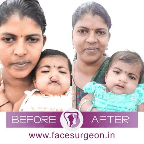 Cleft Lip Palate Treatment India