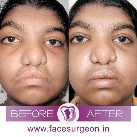 Cleft Lip Palate in India