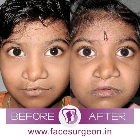 Cleft Lip Revision Surgery India