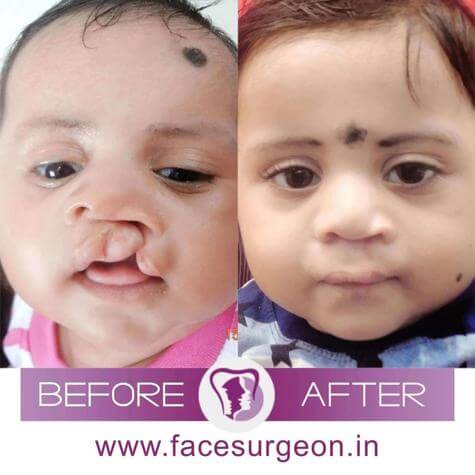 Cleft Lip Surgery India
