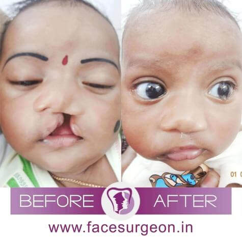 Cleft Lip Treatment India