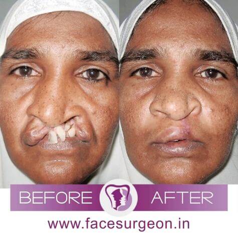 Cleft Lip Treatment in India