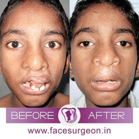 Cleft Palate Revision Surgery India